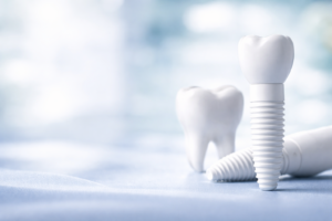 Keramikimplantate in Düsseldorf